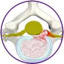 Herniated Disc (Cervical)