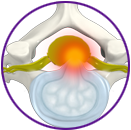 Cervical Disc Protrusion