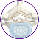 Cervical Stenosis