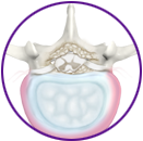 Degenerative Disc Disease