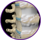 DISH (Diffuse Idiopathic Skeletal Hyperostosis)