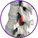 Facet joint arthritis