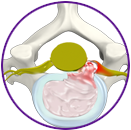 Herniated disc (Cervical)