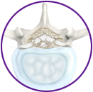 Lumbar Stenosis