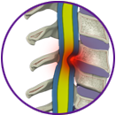 Myelopathy