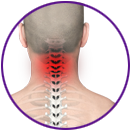 Neck pain