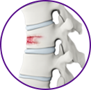 Vertebral Fractures