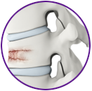 Spinal fractures