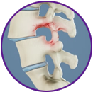 Spondylolisthesis